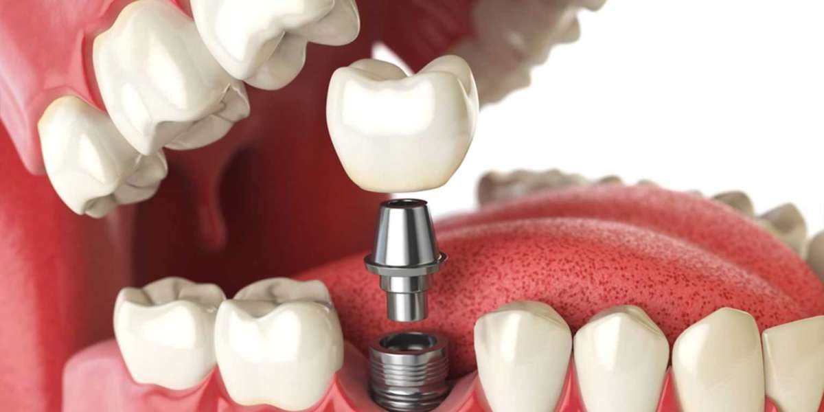 Dental Implants in Dwarka | Best Implantologist in Dwarka | Best Dental Implants in Dwarka | Apex Dental