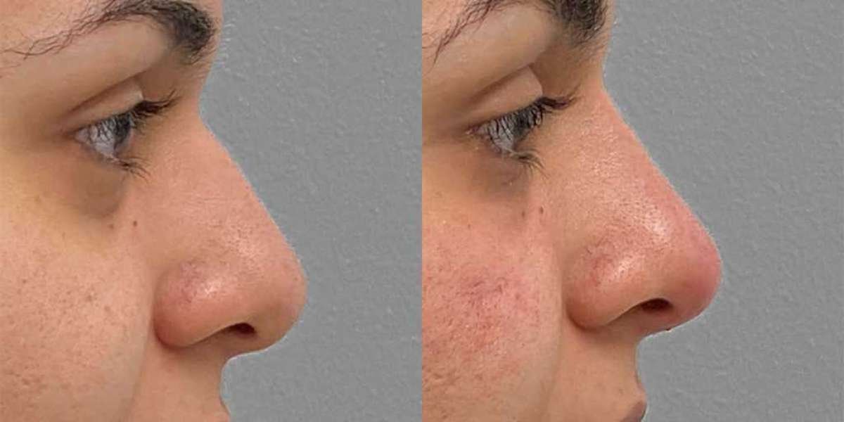 Non-Surgical Nose Correction: Enhancing Beauty Painlessly
