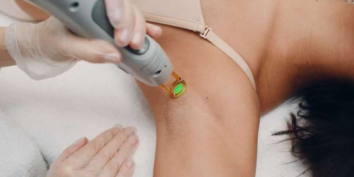 How to Prepare for Your Laser Hair Removal Session in Sydney